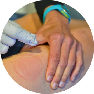aussie-pt-dry-needling